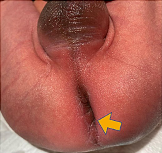 Physical examination of the patient’s anus. Initial physical examination revealed that the anus was in the normal position (arrow).