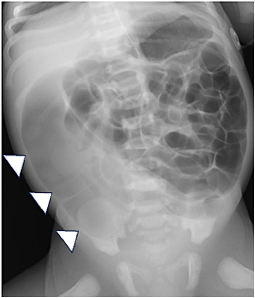 Abdominal X-ray. The X-ray shows diffuse intestinal and colonic distension, especially a dilated sigmoid colon (arrowheads).