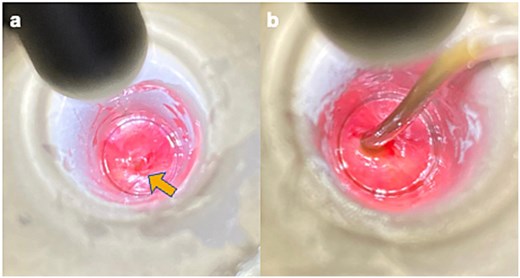 Initial anoscopy examination findings. (a) A rectal web with an orifice (arrow) is observed approximately 1 cm from the anal verge. (b) Dilation of the orifice was performed using catheters ranging in size from 4 Fr to 10Fr, and the 10-Fr catheter was placed through and beyond the orifice.