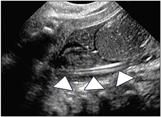 Abdominal ultrasonography. Abdominal ultrasonography showing that the catheter is positioned within the rectum (arrowheads).