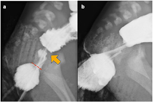 Contrast enema. (a) Preoperative contrast enema showing the rectal web (arrow) located approximately 1 cm from the anal verge (dotted line), with no fistula between the rectum and urethra. (b) Preoperative contrast enema revealing contrast medium stopping above the PC line.