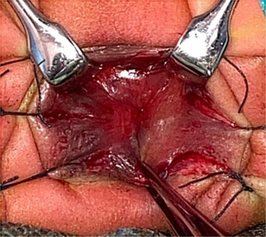 Intraoperative image. Intraoperative findings showing that the lower portion is an anal canal in the normal location, and the stricture, which consisted of a membrane with an orifice, was at a depth of approximately 1 cm. The position of the anal verge was at normal depth.