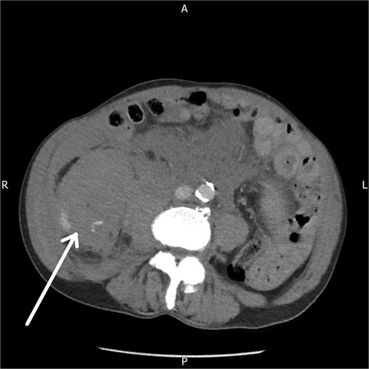 Axial contrast-enhanced CT abdomen and pelvis demonstrating a right-sided retroperitoneal haematoma with evidence of active contrast extravasation.