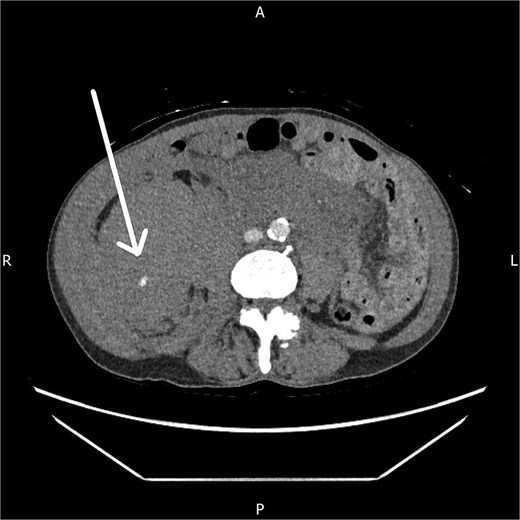 Axial CT angiogram showing persistent right-sided retroperitoneal haematoma with ongoing active contrast extravasation.