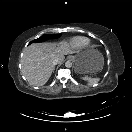 Axial contrast-enhanced CT abdomen on admission showing mottled intramural gas within the gastric wall and associated hepatic portal venous gas in the left lobe, in keeping with emphysematous gastritis.