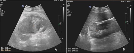 Abdominal ultrasound showing multiple solid masses in both kidneys and a subcapsular hematoma in the left kidney.