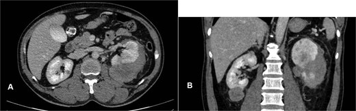 Contrast-enhanced CT showing multiple bilateral renal tumors, a left subcapsular hematoma, a pancreatic uncinate process mass, a right adrenal mass, a right retroperitoneal nodule, and bilateral renal hilum lymphadenopathy.