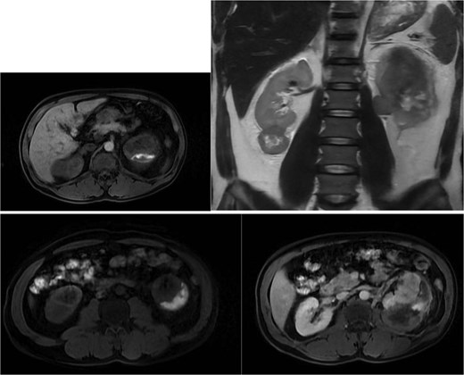 Axial T1-weighted and T2-weighted MRI showing multiple solid renal masses with low signal intensity and a large left subcapsular hematoma.