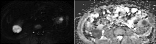 Diffusion-weighted imaging (b = 800) and ADC maps showing restricted diffusion in the viable components of bilateral renal tumors.