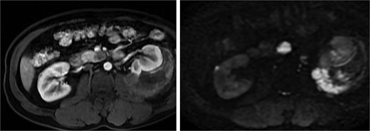 MRI of the pancreatic uncinate process mass showing low T1 signal, mildly increased T2 signal, restricted diffusion, and relative hypoenhancement on post-contrast images.
