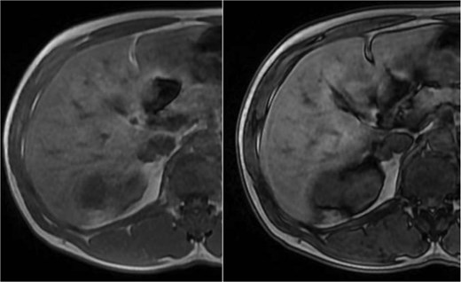 MRI of the right adrenal lesion showing mild T2 hyperintensity, contrast enhancement, and restricted diffusion.