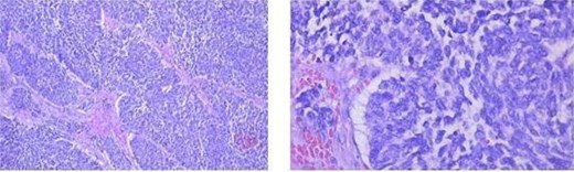 Histopathology showing neuroendocrine carcinoma in the kidney and pancreas (hematoxylin–eosin stain) and lymph node metastasis.
