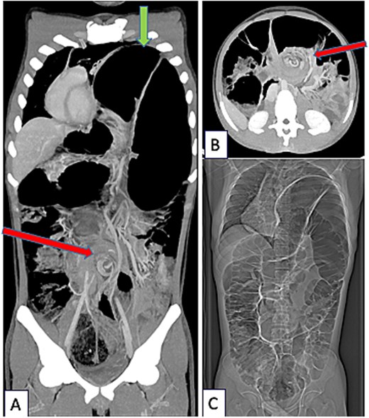 CT-scanner thoracic abdominal and pelvic at portal phase (Siemens X-Cite 2021 Healthcare Erlangen Iomeron 350), coronal (A) and axial view (B). Sigmoid Volvulus with pathognomonic Whirl Sign (arrow in the middle of figures A and B) associated with severe diaphragmatic eventration (arrow at the top of figure A). Complete coronal view (C): global colonic distention.