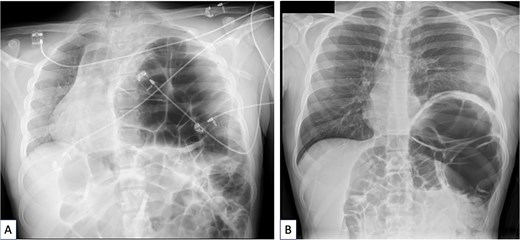 (A) Chest X-ray done when acute sigmoid volvulus occurred, revealing the major diaphragmatic eventration causing severe contralateral mediastinal shift and complete left lung atelectasis. (B) Chest X-ray done 4 months after sigmoidectomy and diaphragm plication. The left lung is well reexpanded and the mediastinum is in good position. The left hemidiaphragm is stabilized at a correct but high level because of persistent megacolon despite sigmoidectomy.