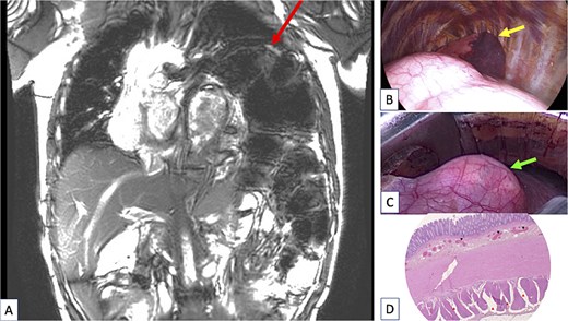 (A) Coronal view of the chest magnetic resonance imaging done after sigmoidectomy showing a huge persistent left diaphragmatic eventration (arrow at the top of figure) containing the remaining large megacolon. The left lung was totally compressed in the upper part of the pleural cavity and a severe mediastinal shift persisted despite digestive surgery. (B) Peroperative view of the thoracic procedure showing the major diaphragm eventration pushing the lung (arrow showing lung) in the upper part the pleural cavity. The lung is almost in full atelectasis. (C) Peroperative view of the thoracic procedure showing a “transparent diaphragm” (arrow showing thin diaphragm) without muscle consistence. (D) Histopathologic examination of the resected colon, using haematoxylin and eosin (H&E) staining. Cross section of the colonic wall (H&E—2.5×) showing small congestive vessels within the submucosal layer (black triangles) and fibrosis dissociating the external muscular layer (red triangles).
