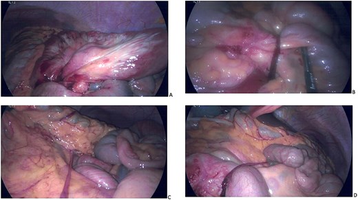 Laparoscopy images.