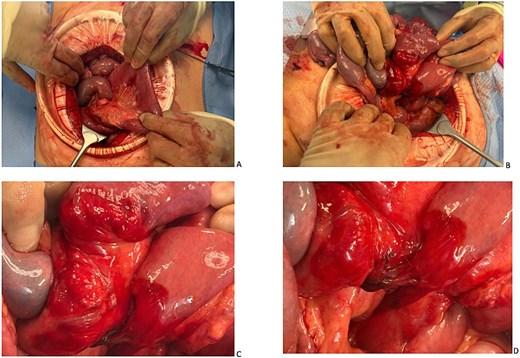 Laparotomy images.