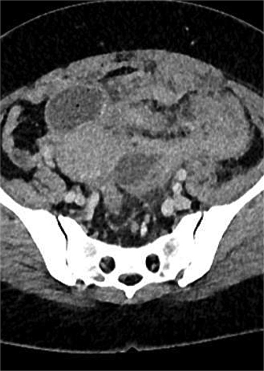 CT scan of abdomen and pelvis: Pelvic mass involving sigmoid colon, uterus, urinary bladder, left fallopian tube and ovary.