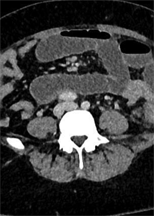 CT scan of abdomen and pelvis: Obstructed loop of small bowel.