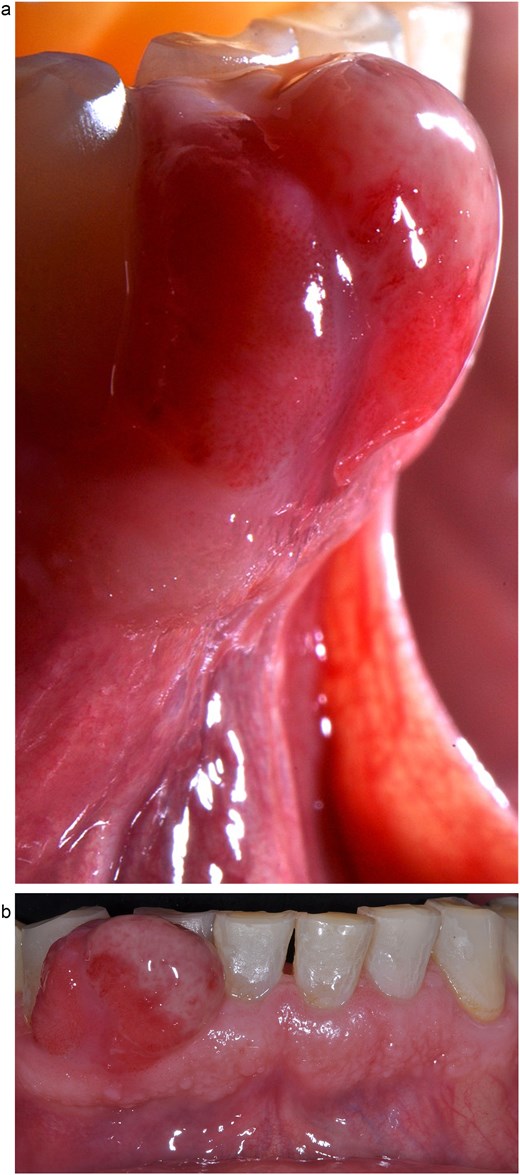 Clinical image of mucogingival tissue growth in the attached gingiva, with a firm, oval, fibrous, smooth appearance and no signs of active ulceration. (a) Lateral view. (b) Frontal view.