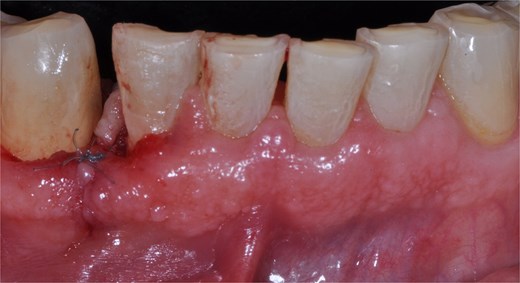 Front view of the clinical image of the removal of the intraoral lesion with a 5-zero nylon suture and simple stitches.