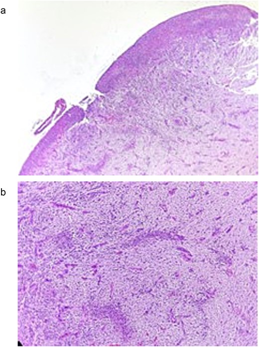 (a) Histological micro-section stained with H&E, showing loss of epithelial continuity and the presence of eosinophilic material consistent with fibrin corresponding to an ulcer. (b) H&E-stained histological micro-section showing granulation tissue consisting of lymphatic and vascular spaces of varying sizes, severe diffuse chronic inflammatory infiltrate, in a stroma of abundant collagen fibers arranged in a loose and irregular manner.