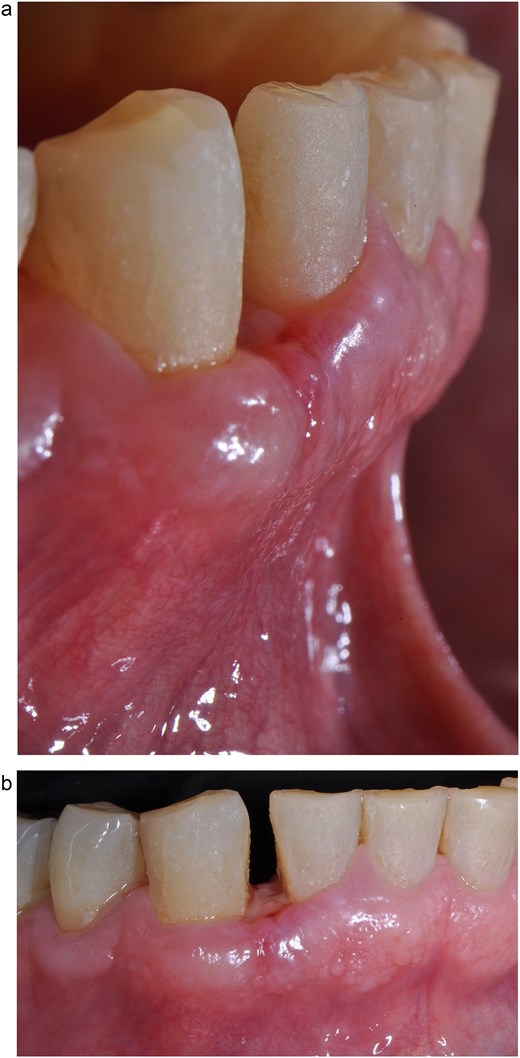 Suture removal 15 days postoperatively. (a) Lateral view. (b) Frontal view.