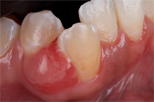 Front view of the clinical image of the intraoral lesion: Growth of mucogingival tissue in the attached gingiva, with a firm, oval, fibrous, smooth appearance and without signs of active ulceration.