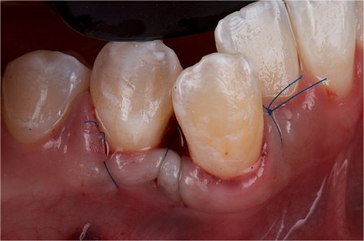 Front view of the clinical image of the removal of the intraoral lesion with simple 5-point nylon suture and suspension stitches.