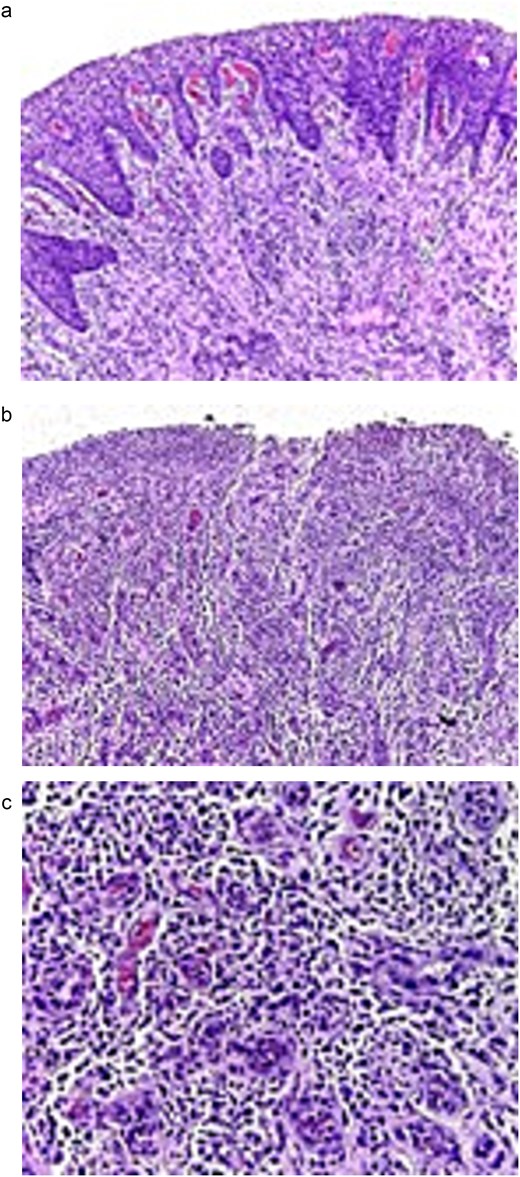 Histological micro-sections stained with H&E. (a) The lesion is covered by a stratified squamous epithelium that is not keratinized, which exhibits signs associated with inflammation (10×). (b) Towards one field, there is a loss of epithelial continuity consistent with ulceration (10×). (c) At higher magnification, hyperplasia of granulation tissue is observed, consisting of numerous blood capillaries, some with erythrocytes in their lumen, severe mixed inflammatory infiltrate, fibroblasts, and collagen fibers.