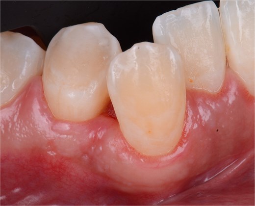 Front view of the clinical image of suture removal 15 days postoperatively.