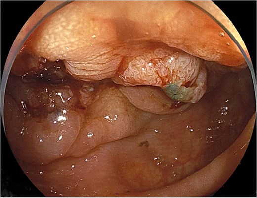 Circumferential type II tumor with severe stenosis in the descending colon.