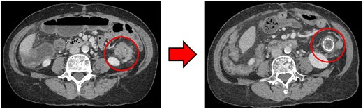 (Left: Before NAC) Wall thickening of the descending colon with increased pericolic fat tissue density. (Right: After NAC) Significant shrinkage of the primary lesion.