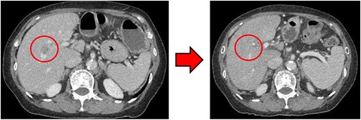 (Left: Before NAC) Liver metastasis in the liver S5/7. It was located near the anterior branch of the portal vein and the right hepatic vein. (Right: After NAC) Liver metastasis in the liver S5/7. Complete resolution of the S5/7 liver metastasis.