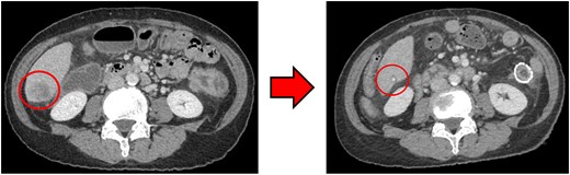 (Left: Before NAC) Liver metastasis in the liver S6. (Right: After NAC) Liver metastasis in the liver S6. It had decreased substantially, with near-complete necrosis.