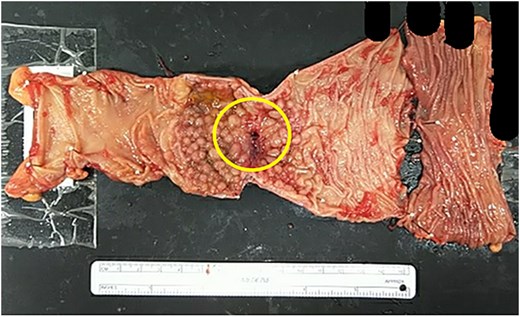 Resected specimen. Scar tissue corresponding to the primary site was identified in the resected specimen.