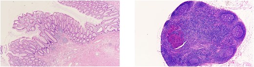 (Left) Primary site. No residual tumor cells were observed. (Right) Lymph nodes. No lymph node metastases were found.