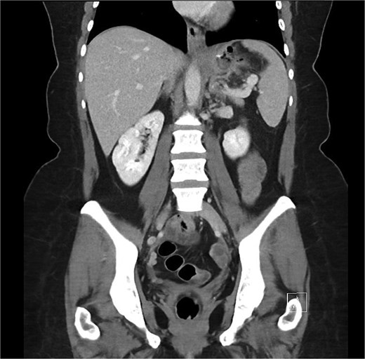Coronal portal venous phase CT scan of the abdomen and pelvis demonstrating the proximal gastric leak with extra-luminal air in the gastrosplenic ligament.