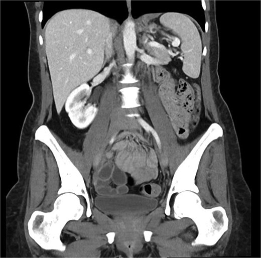 Coronal portal venous phase CT scan of the abdomen and pelvis demonstrating the thickening of the left hemidiaphragm but nil evidence of ongoing leak.