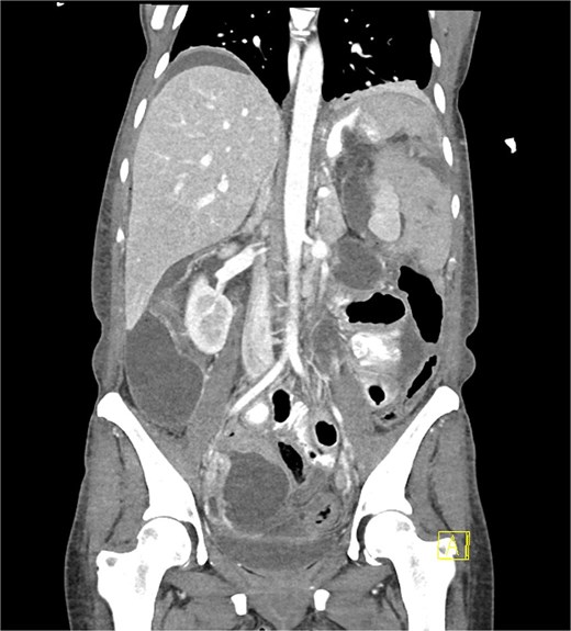 Coronal portal venous phase CT scan with oral contrast of the abdomen and pelvis demonstrating the proximal gastric leak with large volume contrast extravasation into the left upper quadrant and widespread intra-abdominal fluid with pneumoperitoneum.
