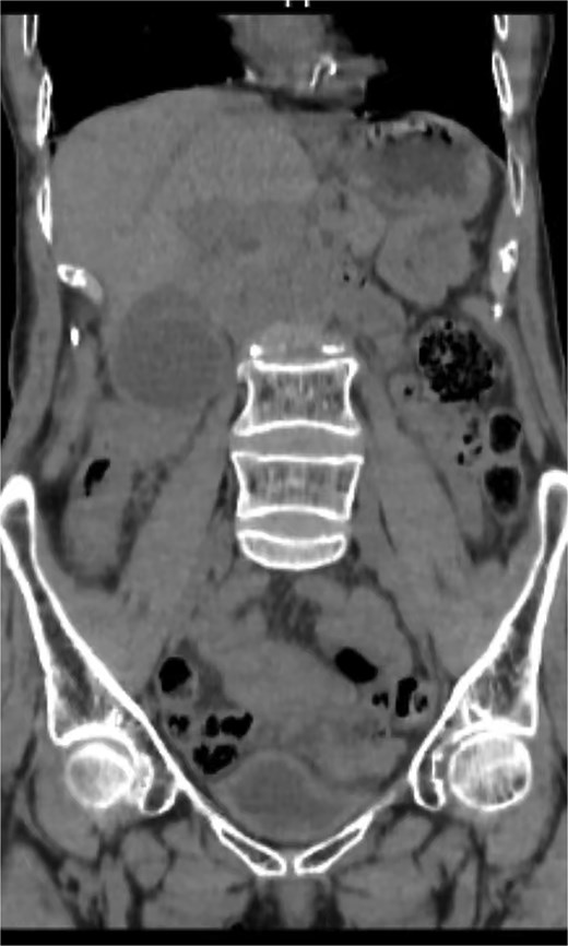 CT showing a distended gallbladder.