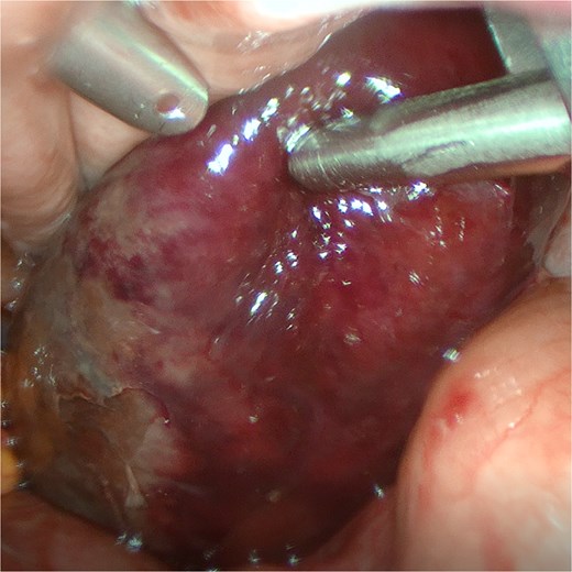 The gangrenous gallbladder founding during the operation.