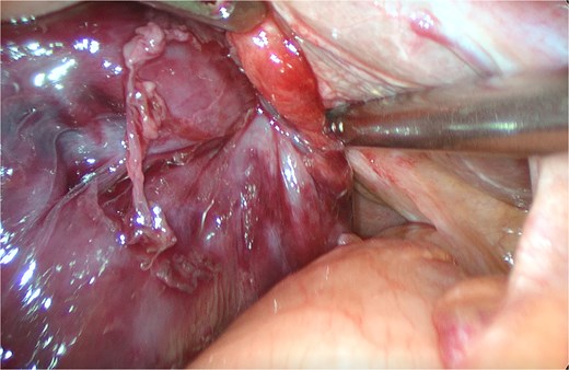 Identification of the twisted part of the gallbladder.