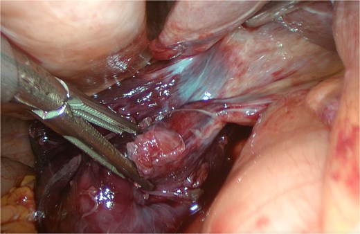 View of the gallbladder after detorsion.