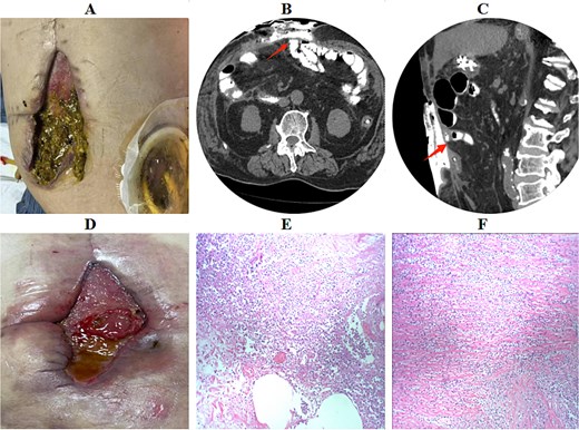 Clinical photographs and imaging findings of the EAF. (A) Appearance of the newly developed fistula in the OA. (B and C) Contrast-enhanced fistulography demonstrating communication with the small bowel. (D) Enlargement of the fistula after repeated attempts at isolation. (E and F) histopathology showing acute inflammation with focal mucosal necrosis.