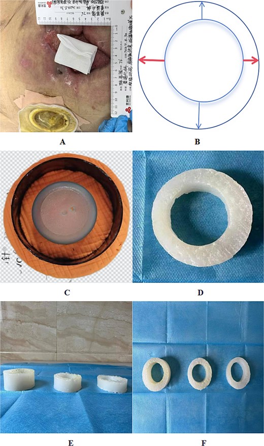 Schematic representation of customized silicone stoma fabrication process. (A) Measurement of wound dimensions and fistula-to-skin distance. (B) Determination of asymmetric ring width for improved adaptation. (C) Preparation of the lower mold base with a textured surface to enhance friction. (D) Final silicone ring following polymerization.