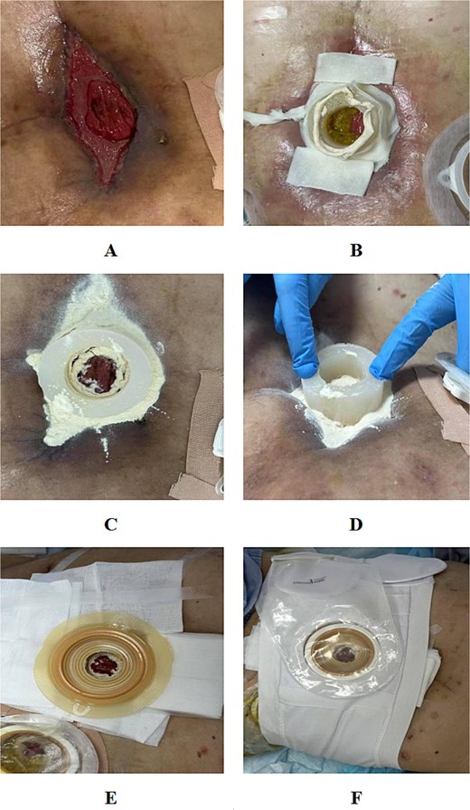 Application process of the customized silicone floating stoma. (A) Wound cleansing and preparation. (B) Shaping of the silicone ring to fit wound contours. (C) Placement of strip paste to improve adhesion. (D) Coverage of surrounding granulation tissue with petrolatum gauze. (E) Application of ostomy barrier and fixation. (F) Final configuration with ostomy pouch attached.