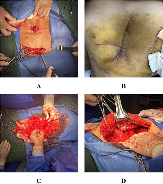 Fistulectomy and abdominal wall reconstruction. (A) Lateral surgical approach to avoid injury to exposed viscera. (B) Adhesiolysis and mobilization of the affected bowel loop. (C) Excision of the fistulous segment. (D) Well-healed postoperative incision at one-month follow-up.