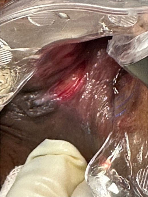Typical finding of a CAF. CAF showing lack of granulation tissue, visible internal sphincter fibers at the base of the fissure, and a sentinel pile at the distal end of the fissure.