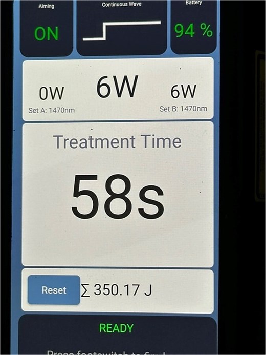 Leonardo mini diode laser (Biolitec Germany). Diode laser with the settings for LaFiP.